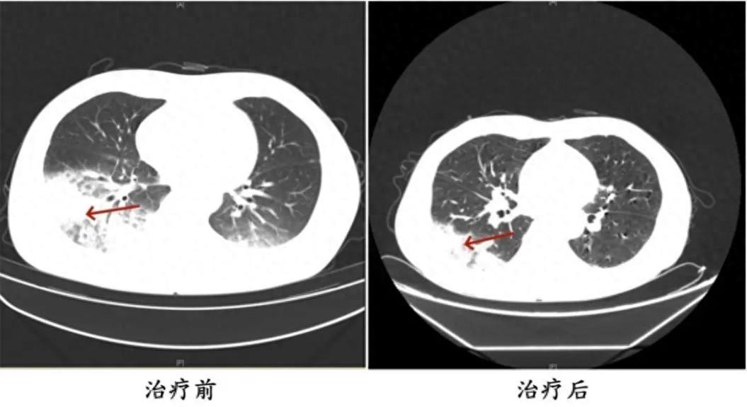 接连有人确诊，严重者可致死！传染源可能是它，最近几乎家家都在用……医生提醒-354人感染