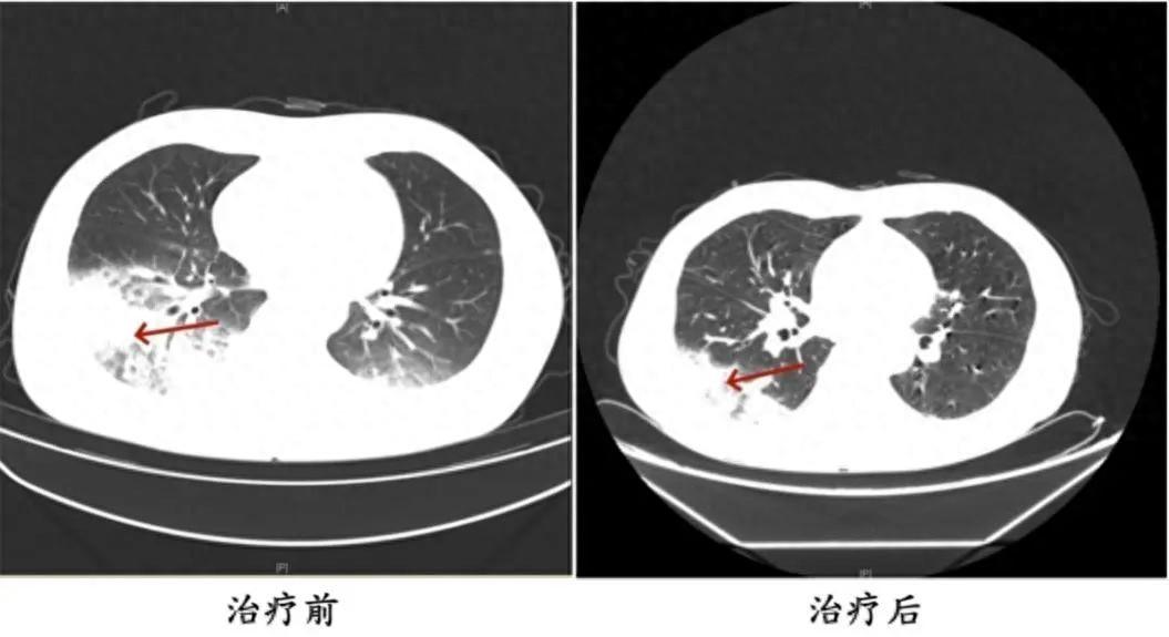 发热、寒战、咳嗽……接连两人确诊，严重可致死！几乎家家都在用，医生紧急提醒→-寒咳发烧吃什么药止咳效果好